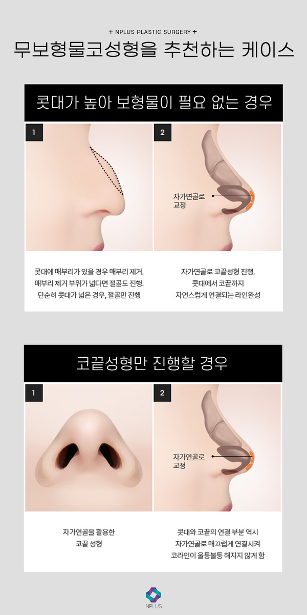무보형물 코수술 자연스러운 코끝성형 관련 이미지 7