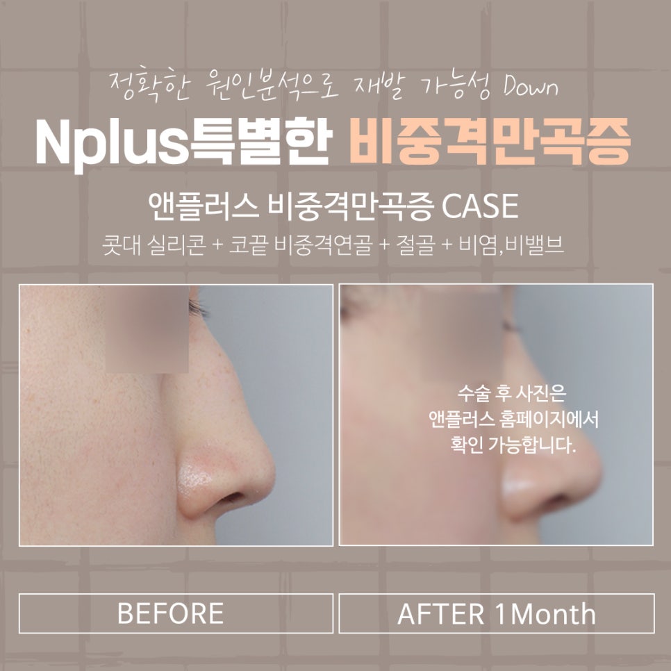 비중격만곡증수술후기 신중하게 고려하여 관련 이미지 13