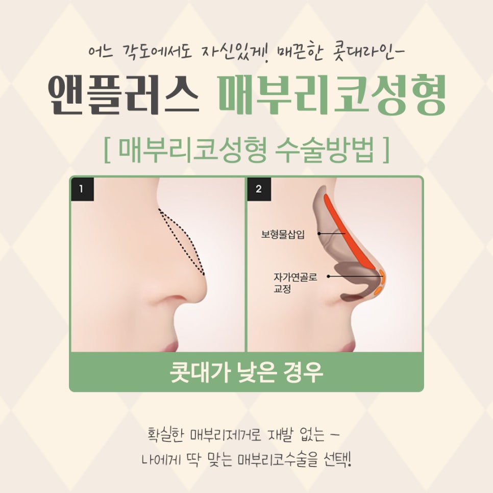 매부리코교정으로 달라진 전후를 확인하고 관련 이미지 10