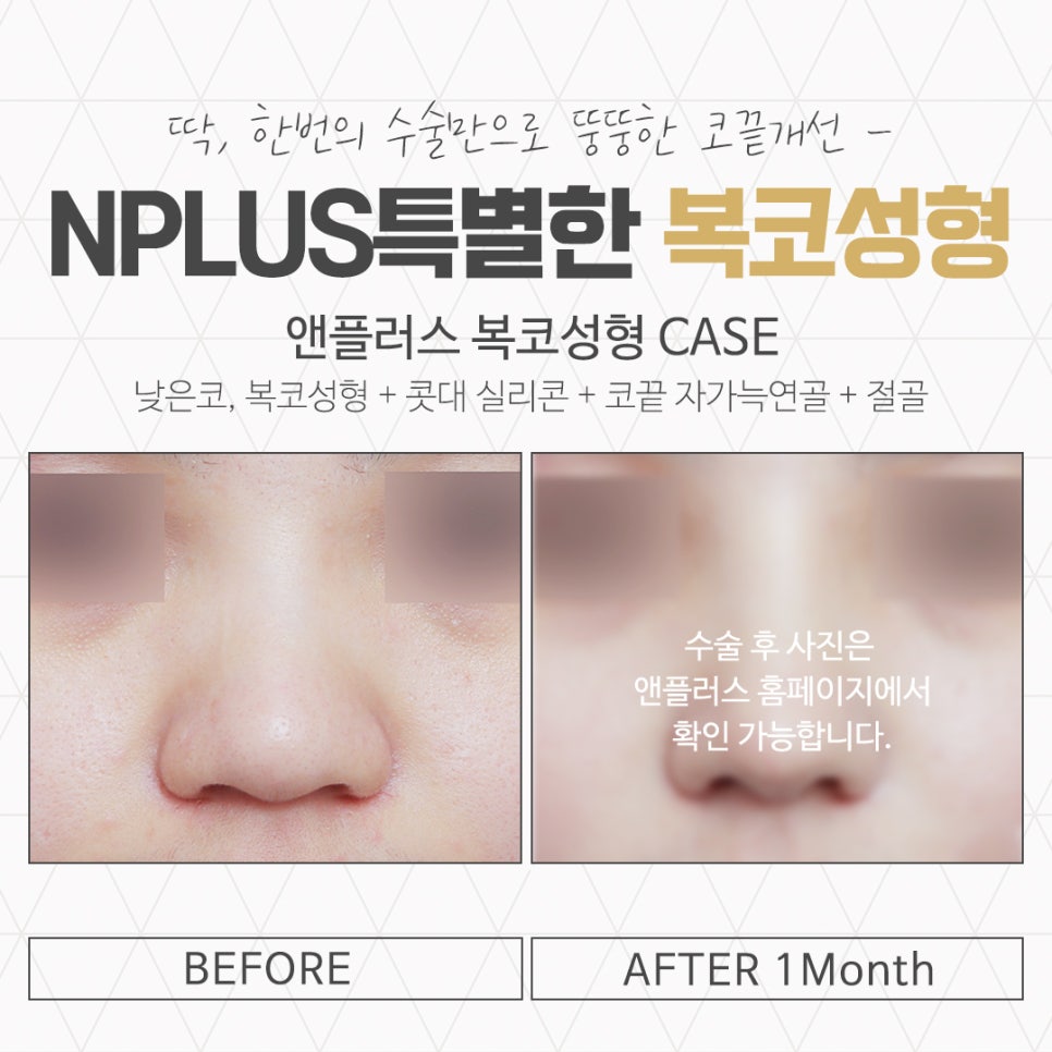 Understanding the Cause of Bulbous Nose Surgery Accurately image 15