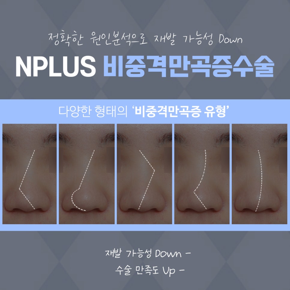 비중격코성형 정확한 원인 파악으로 관련 이미지 7