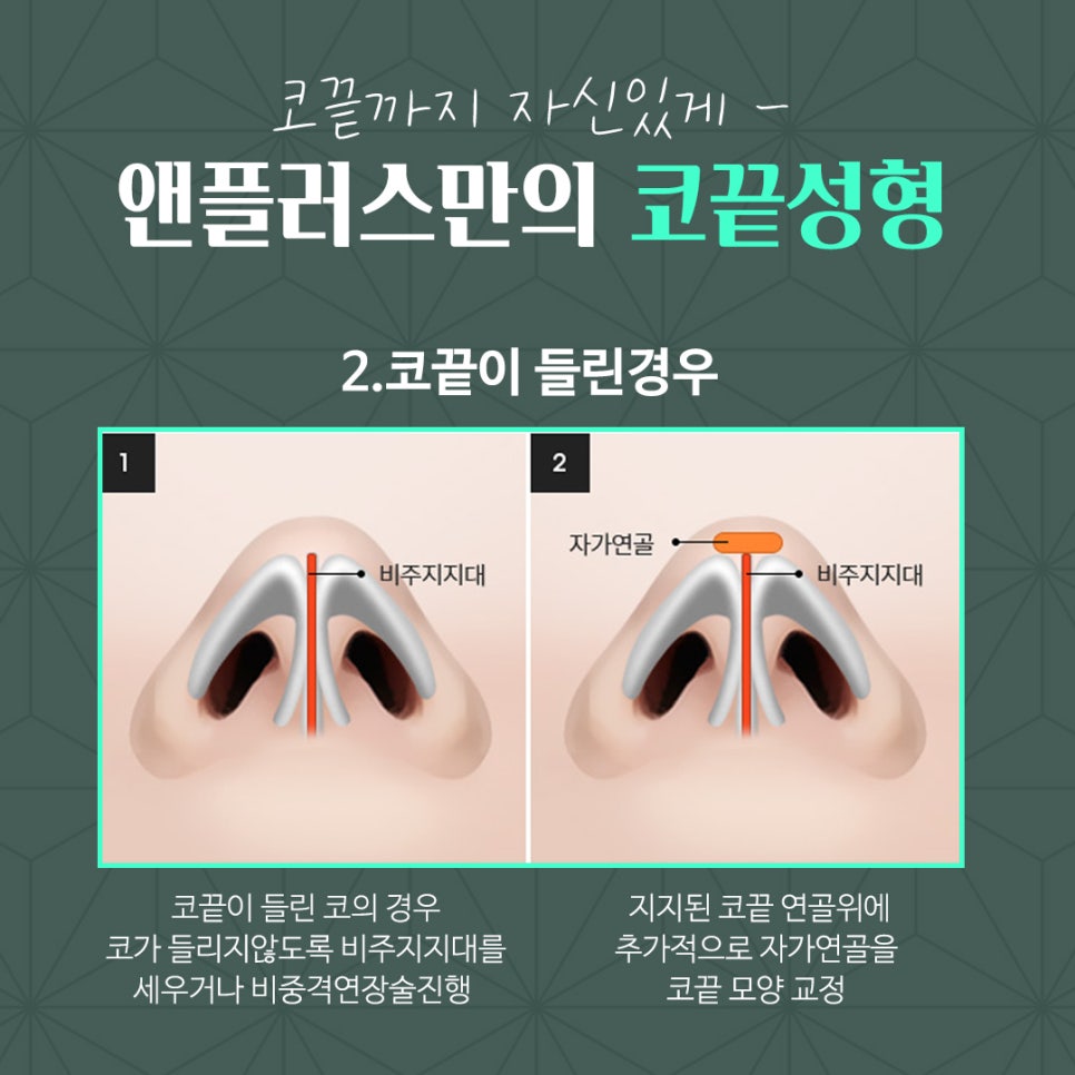 코끝연골묶기 활용한 코끝성형 관련 이미지 7