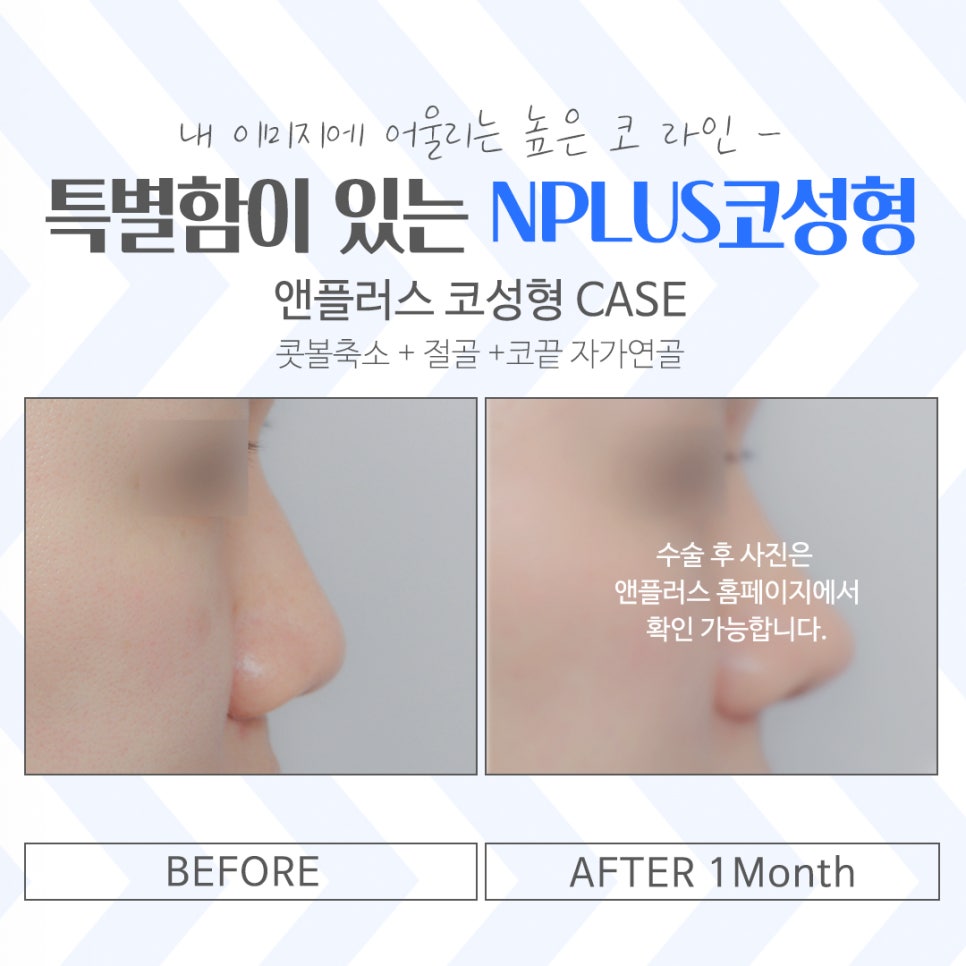 Learn More at a Place Known for Rhinoplasty image 14
