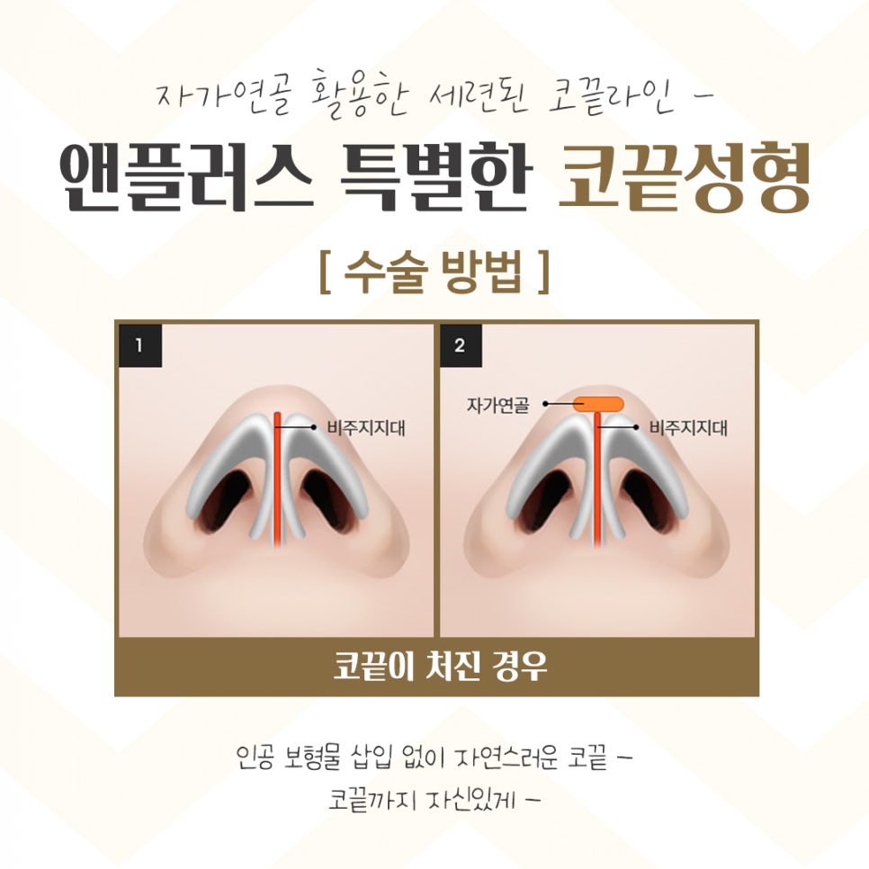 코끝수술후기 다양한 정보를 알아보고 관련 이미지 8