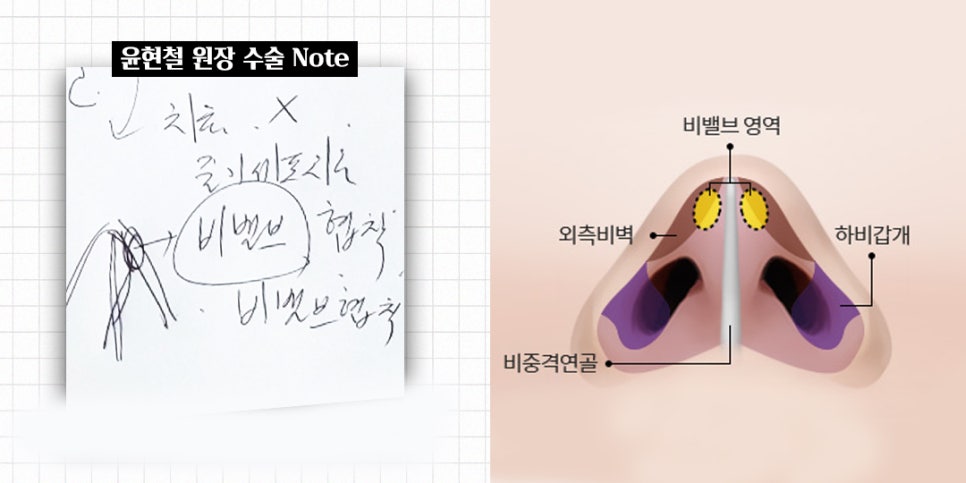 비염코성형에 대한 모든 것 완벽 정리 관련 이미지 5