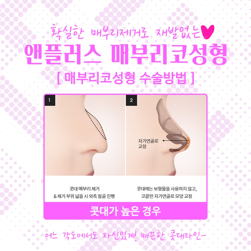Women’s Hump Nose: The Hump Should Be Cleanly Removed image 7