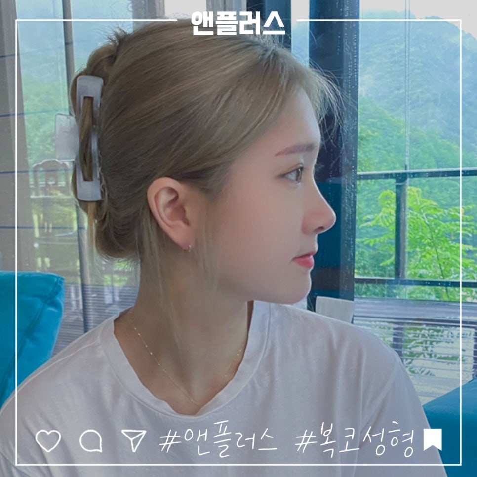 복코수술후기 세련된 인상으로 관련 이미지 15