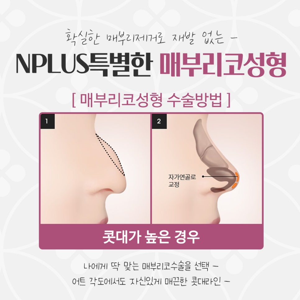 매부리코수술후기 예쁜코라인으로 관련 이미지 10
