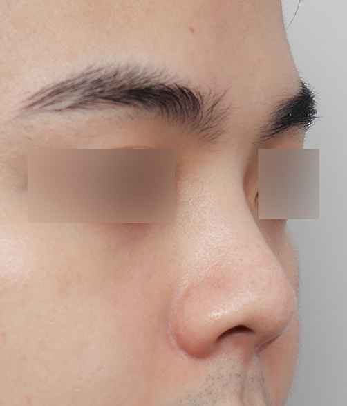 Natural and Satisfying Non-Implant Nose Surgery for Men image 4