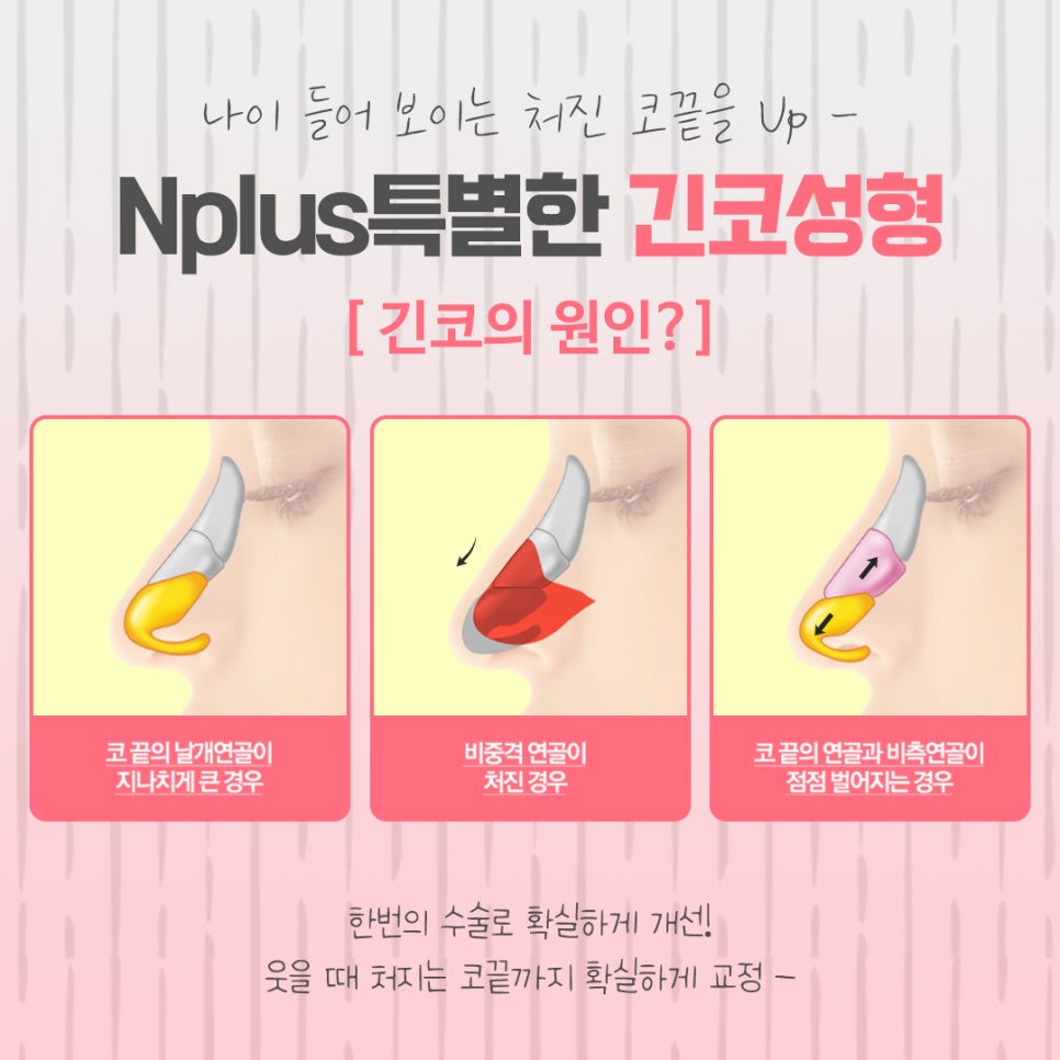 긴코성형 자연스럽게 교정하여 관련 이미지 5