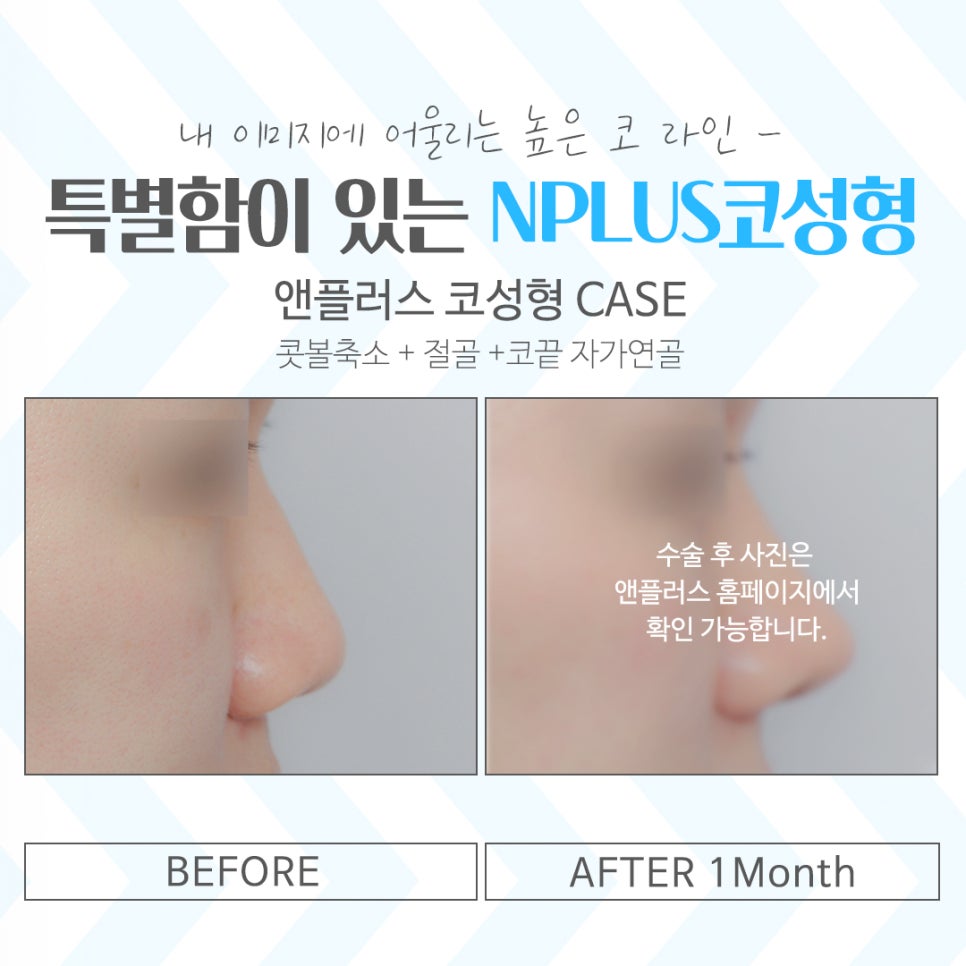 코성형잘하는곳에서 차이를 알아보고 관련 이미지 14