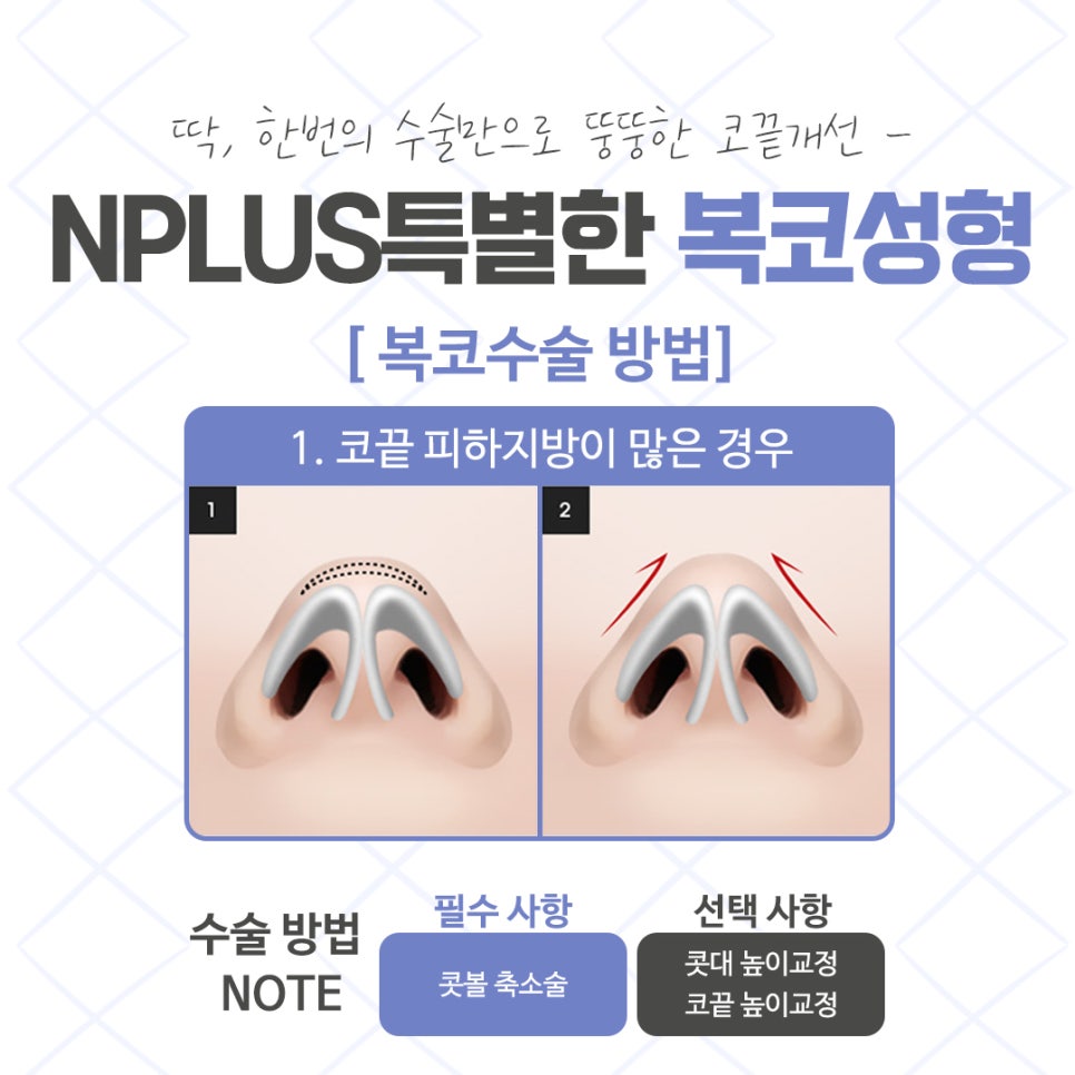 Post-Operative Review of Bulbous Nose Surgery, Improved Naturally image 7