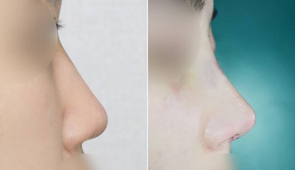 낮은코성형후기 전후사진 관련 이미지 1