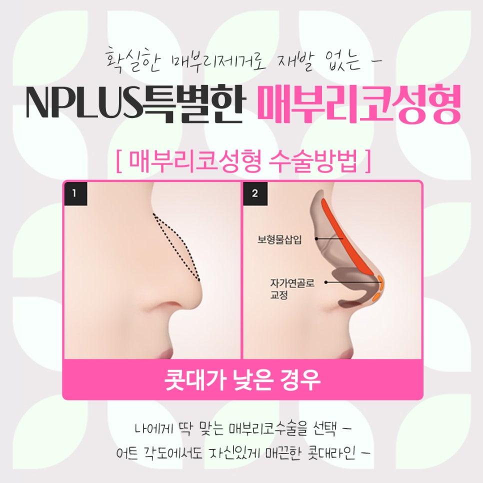 A Refined Look Through Female Hump Nose Surgery image 10