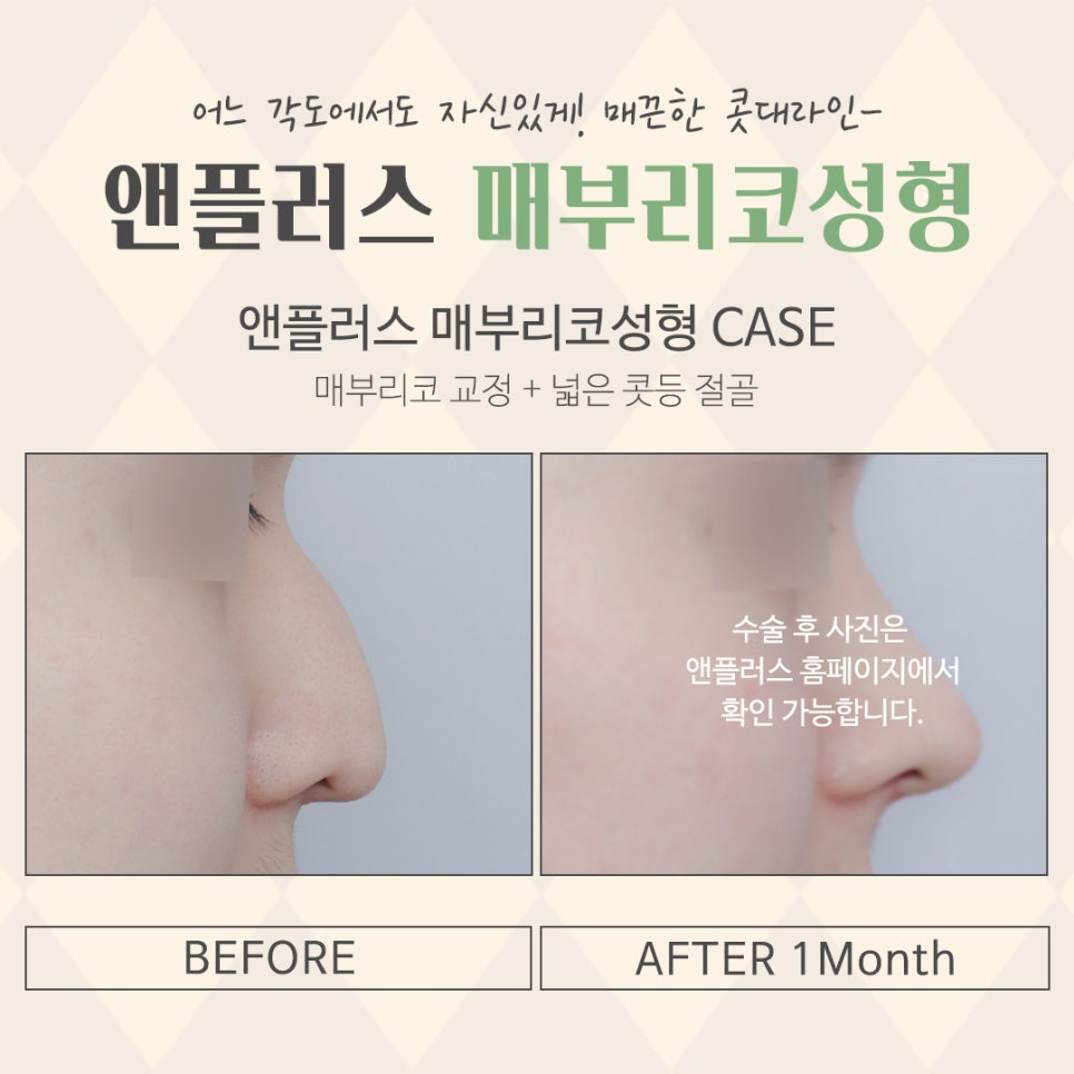 매부리코교정으로 달라진 전후를 확인하고 관련 이미지 15