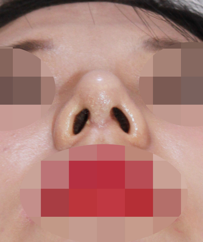 1_여자 매부리코 수술전후 관련 이미지 11