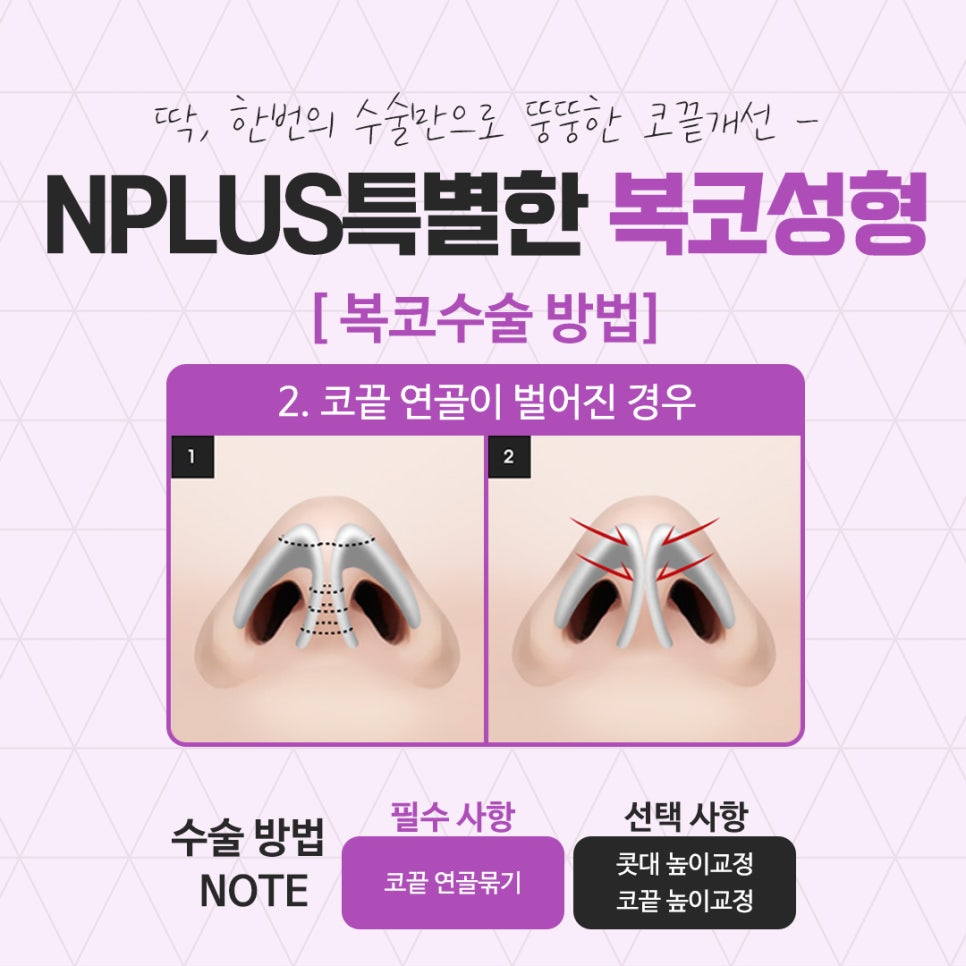 복코수술후기에 대해 세세하게 알아보고 관련 이미지 9