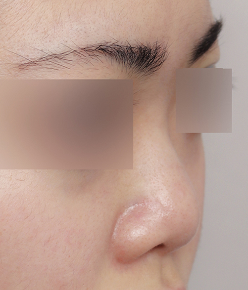 Upturned Nose Surgery_Naturally with Tip Lengthening image 7