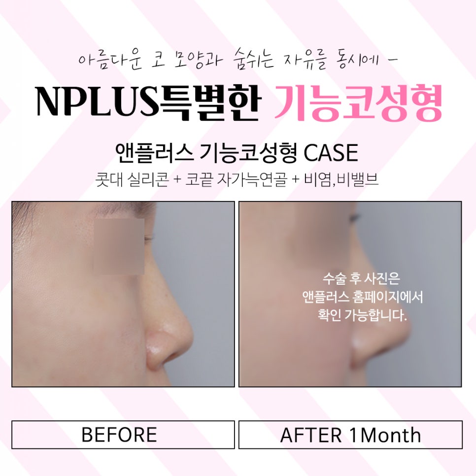 앤플러스 기능코수술후기 선택의 중요성 관련 이미지 15