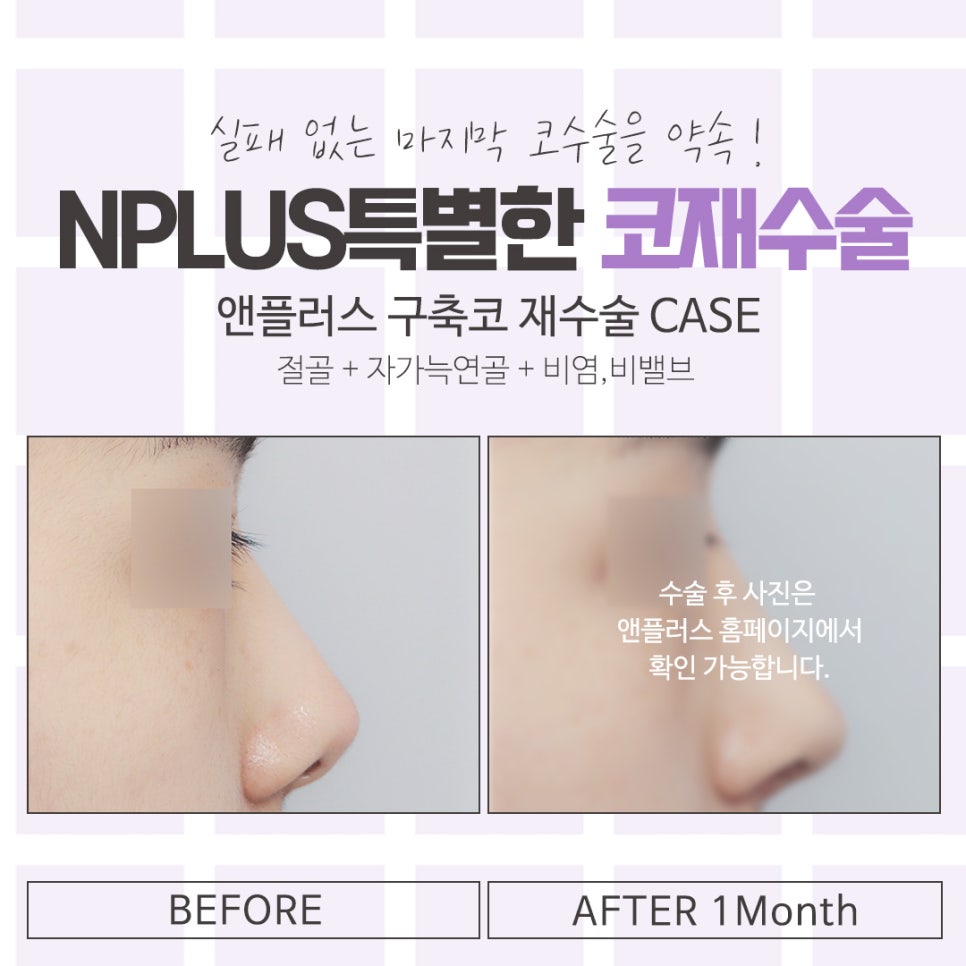 A Careful Look at the Best Place for Nose Revision Surgery image 15