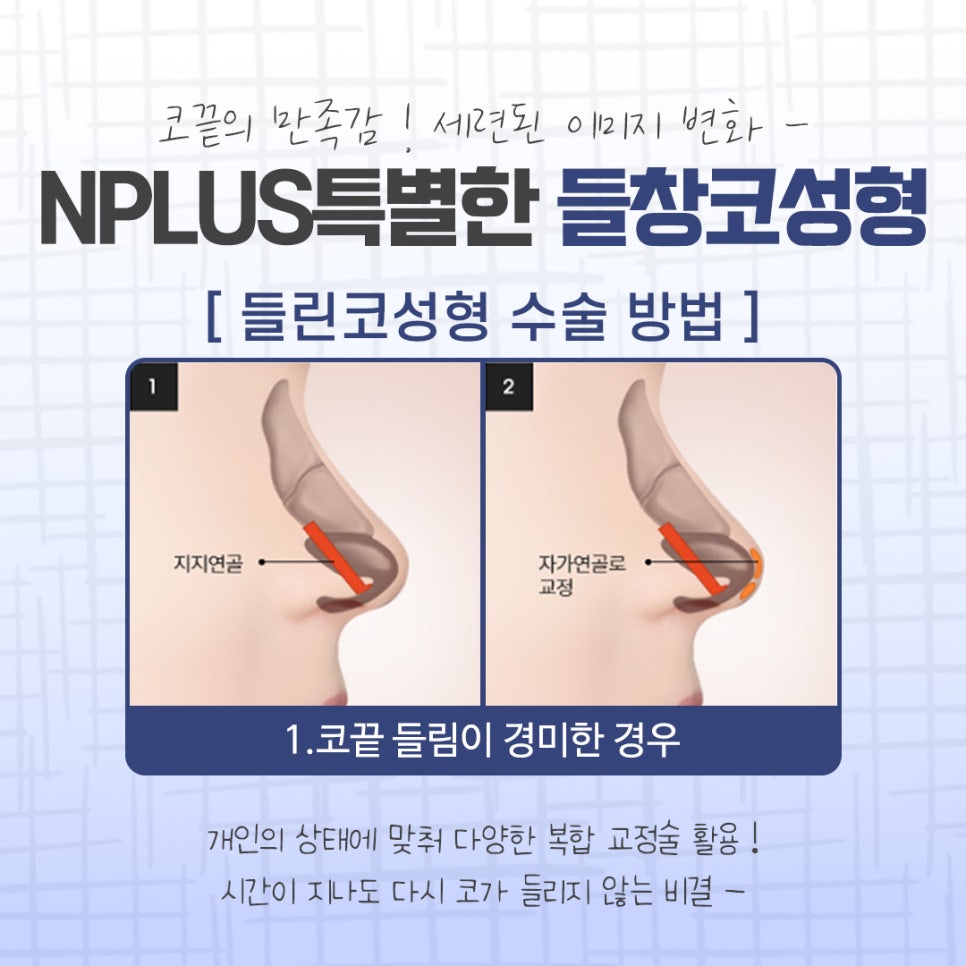 들창코성형 후기를 비교해 보고 관련 이미지 8