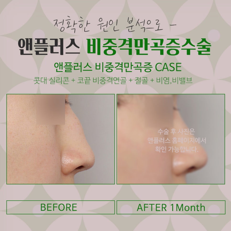 비중격만곡증 수술방법 확인하여 관련 이미지 11