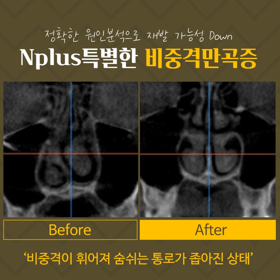 Septoplasty Methods and Causes image 4