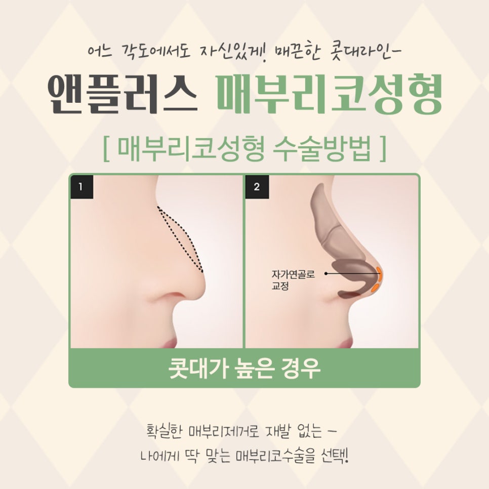 매부리코교정으로 달라진 전후를 확인하고 관련 이미지 9