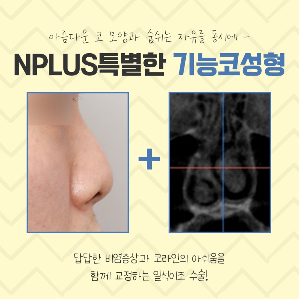 A Clear Choice for Rhinitis Nose Surgery image 3