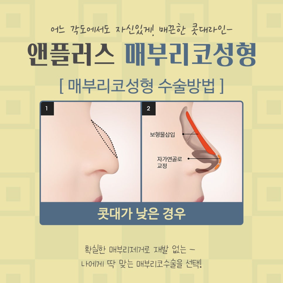 Nose Surgery Review for Correcting a Hump Nose image 10
