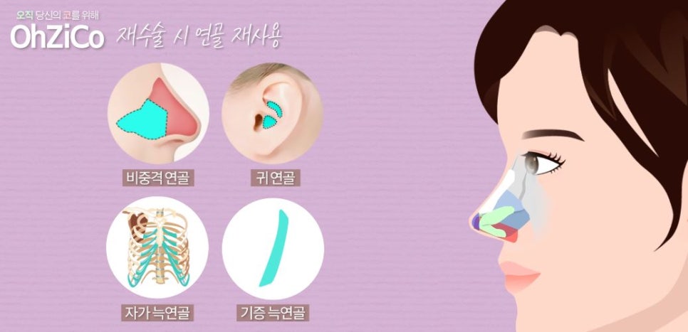 Let Us Explain Whether Cartilage Can Be Reused in Revision Rhinoplasty! image 4