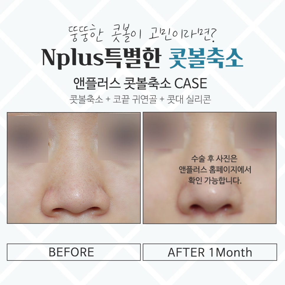 Choosing After Checking Rhinoplasty Alar Reduction Surgery Reviews image 13