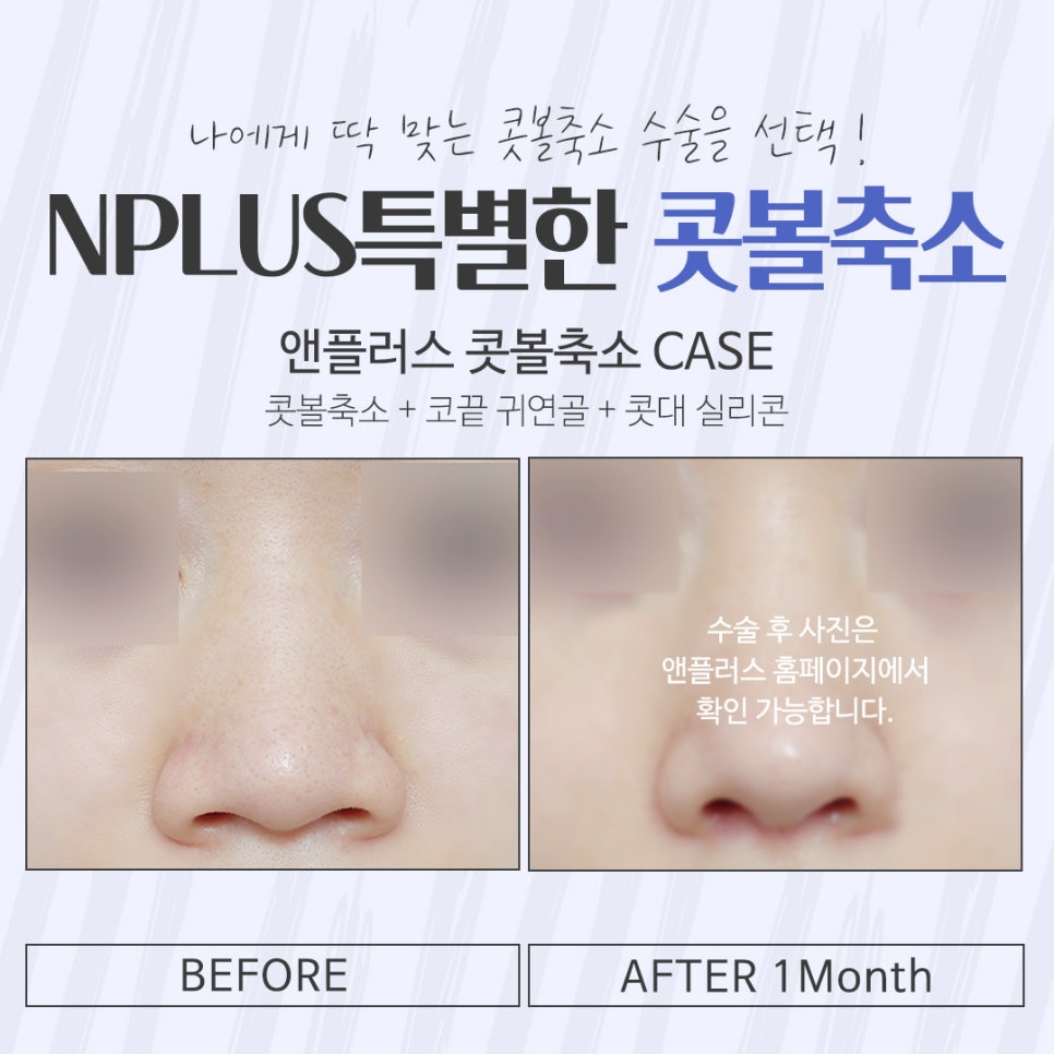 The Importance of Choosing a Nostril Reduction Review image 12