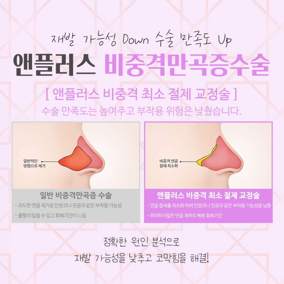 비중격만곡증수술후기 원인과 해결 방법까지 관련 이미지 9
