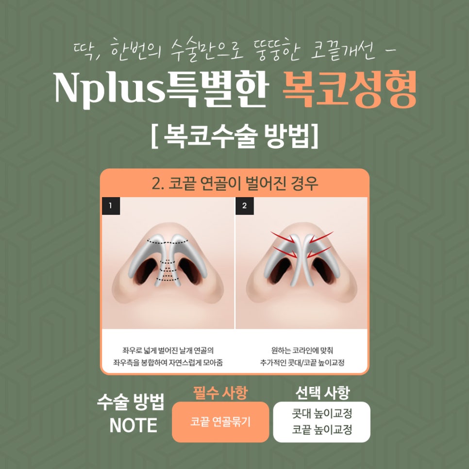 Rhinoplasty Review for a Bulbous Nose Through Nose Fat Removal image 7