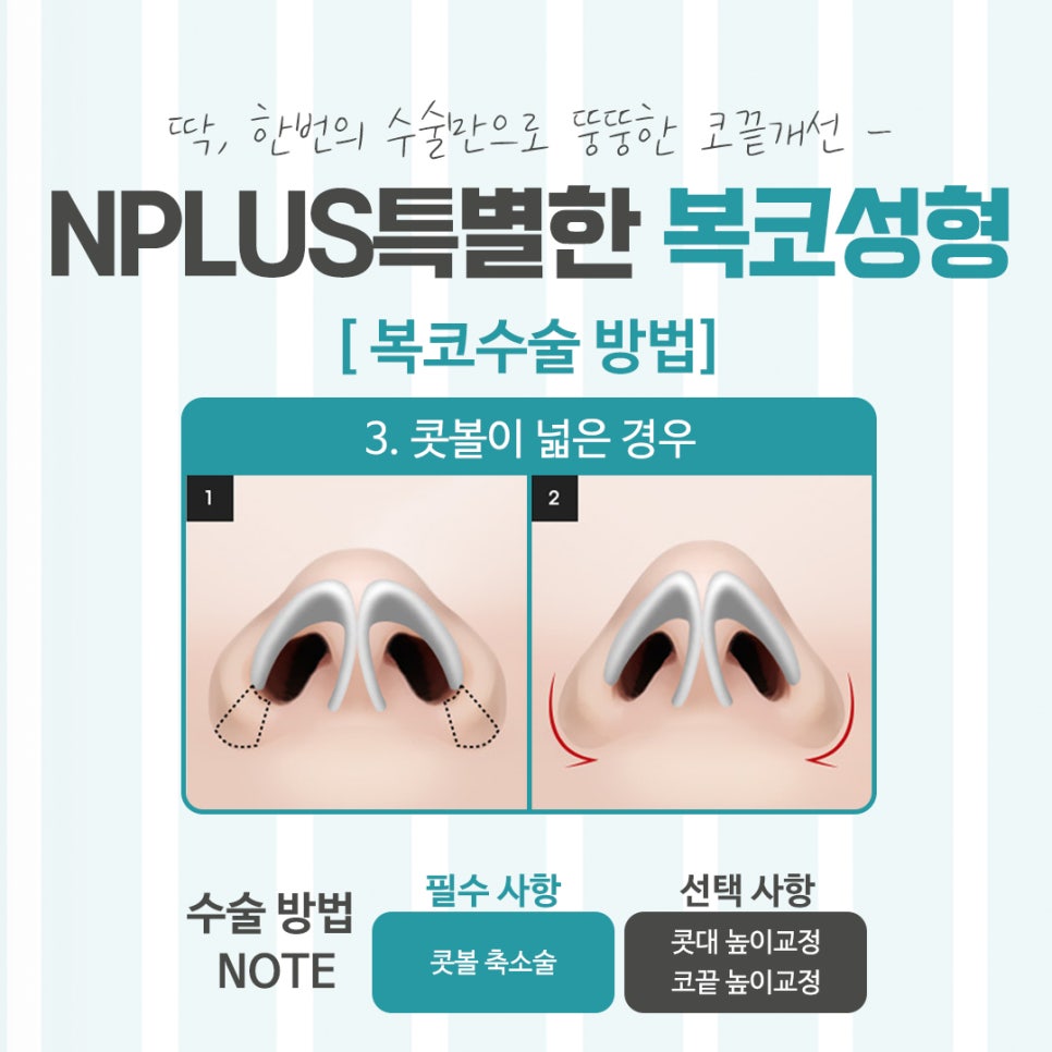 복코수술전후 확실한 차이를 알아보고 관련 이미지 9