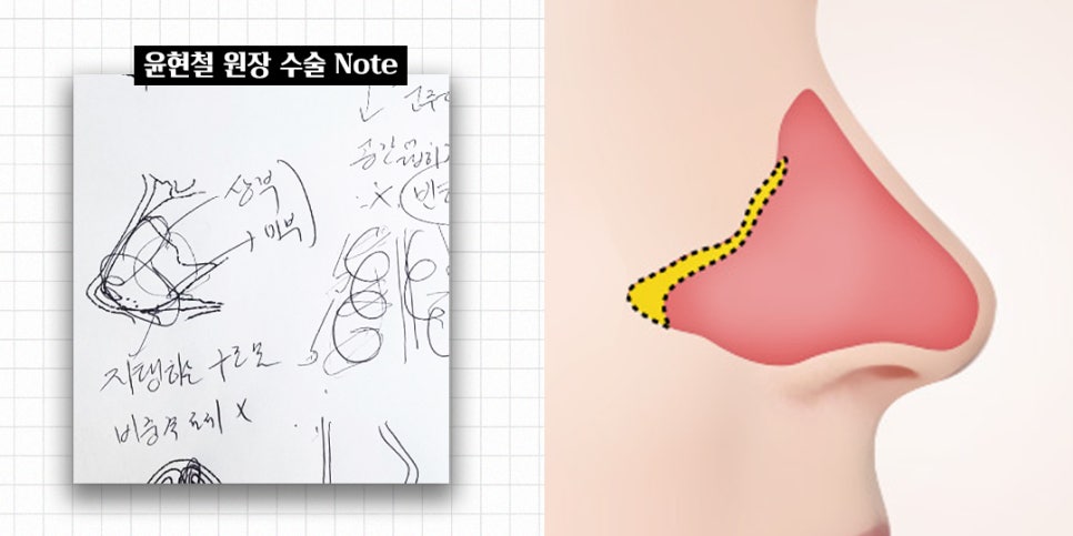 비염코성형에 대한 모든 것 완벽 정리 관련 이미지 4