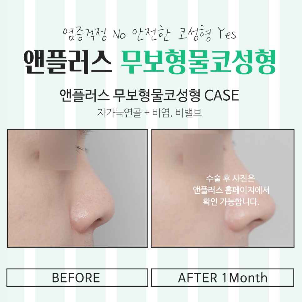 Take a Detailed Look at Reviews of Non-Implant Nose Surgery image 14