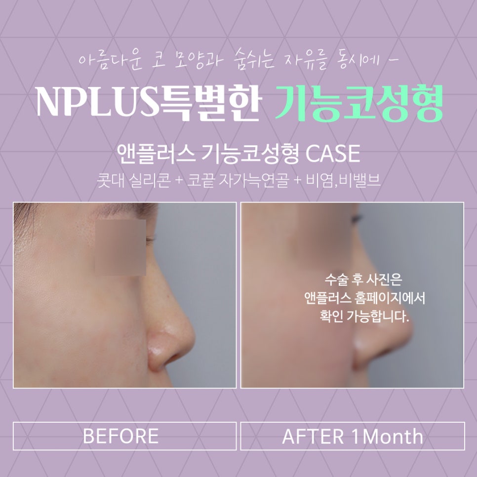 앤플러스의원에서 알려드리는 기능코성형 관련 이미지 14