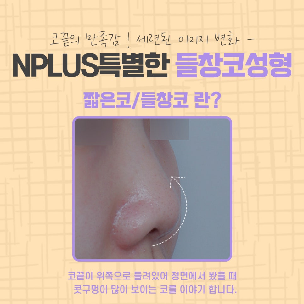 들창코성형 후기까지 알아보고 관련 이미지 4