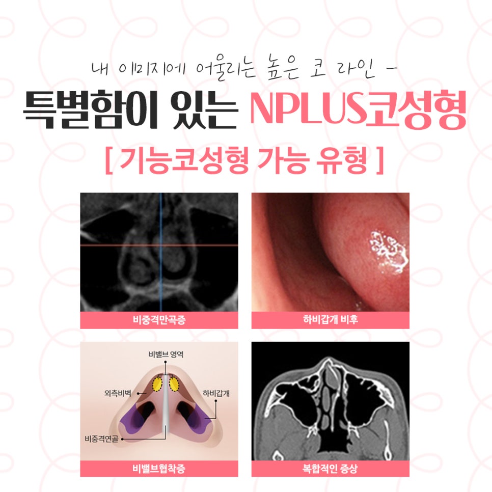 코수술후기 정확한 진단으로 관련 이미지 5