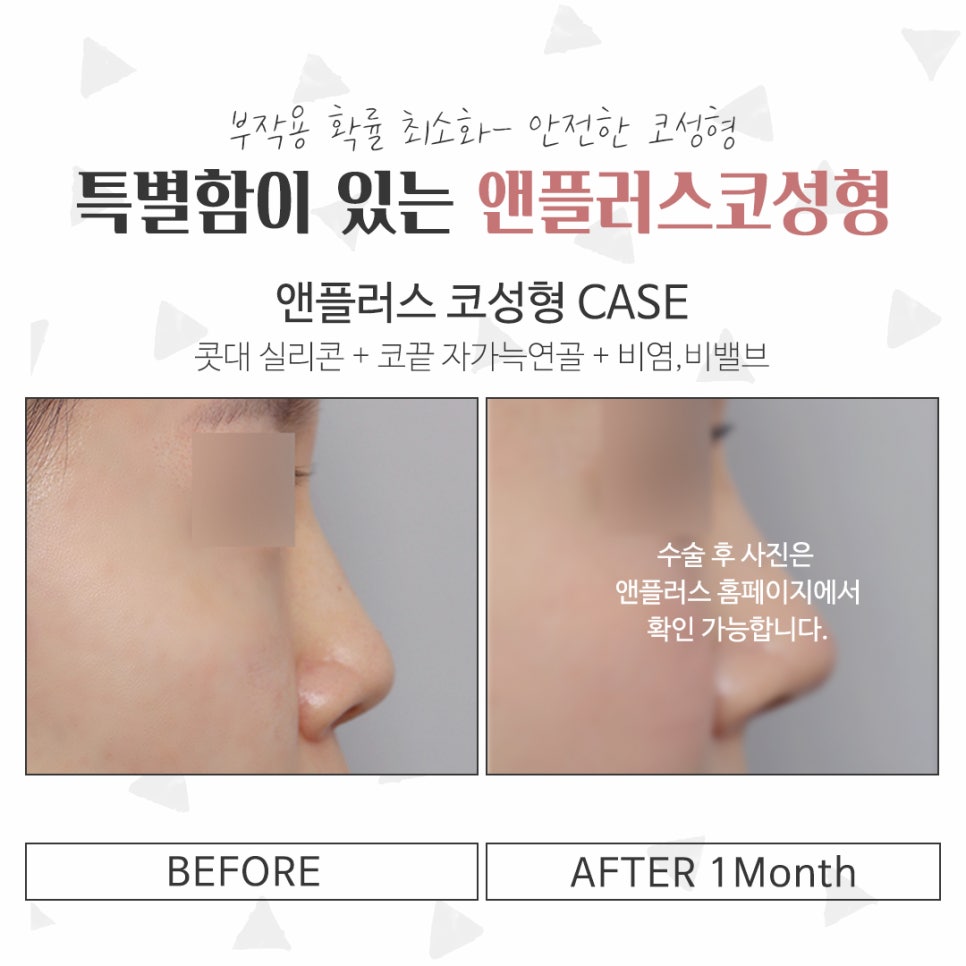 Before and After Female Nose Surgery for a Satisfying Result image 16