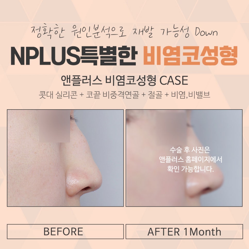 A Satisfying Result with One Rhinoplasty and Rhinitis Surgery image 15