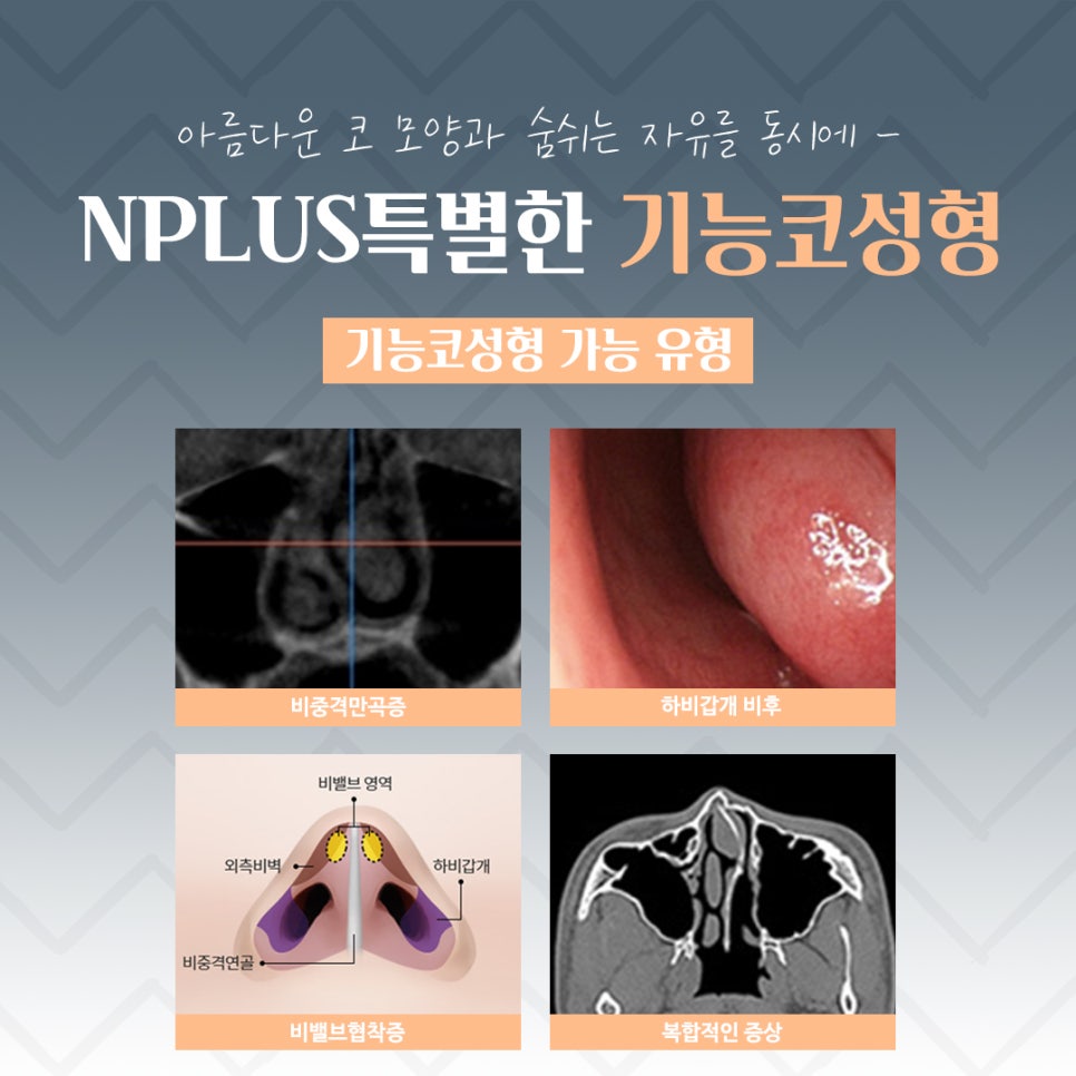 If You Are Looking in Detail at Functional Nose Surgery Before and After image 5