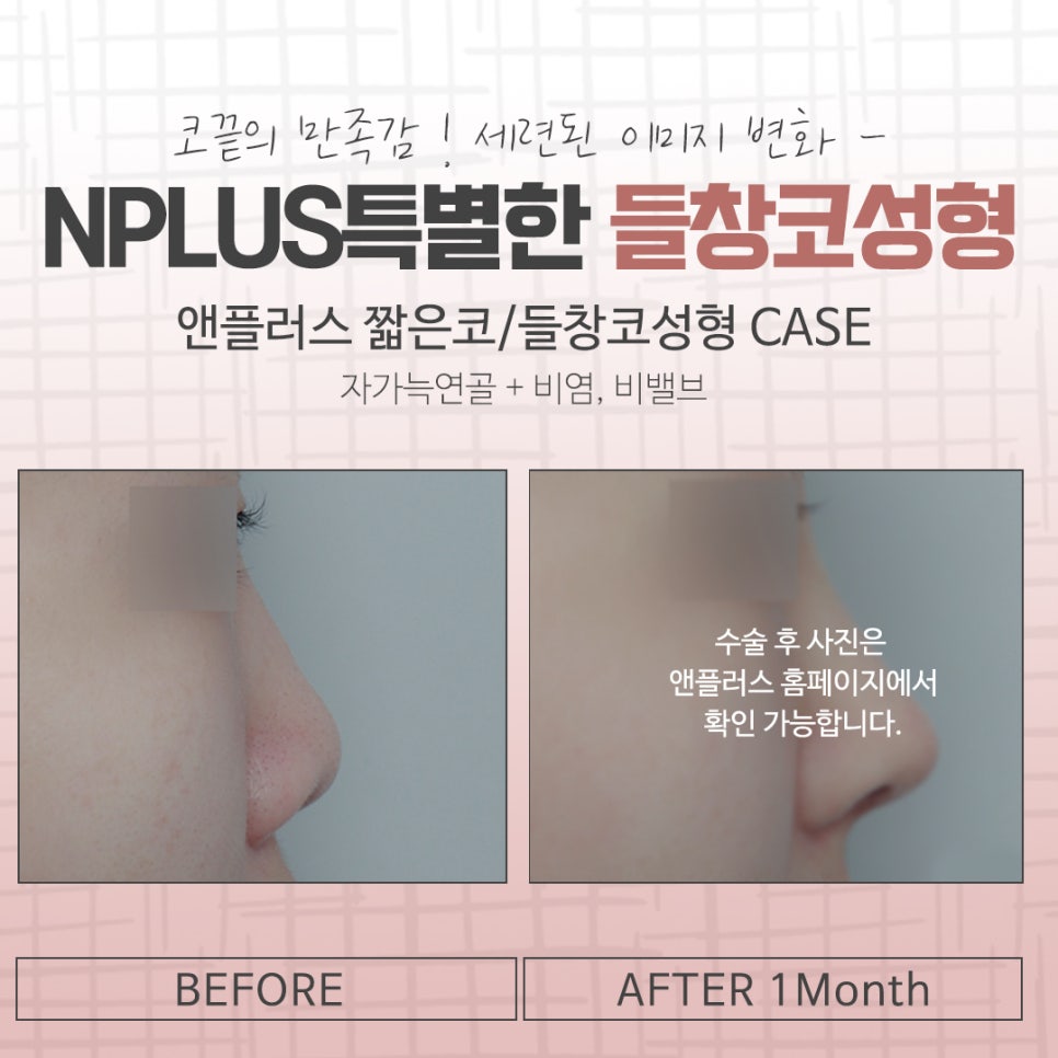 A Refined Look After Reviewing Upturned Nose Surgery Results image 14