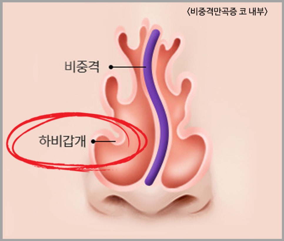 비염코성형? 어렵지 않아요. 관련 이미지 6