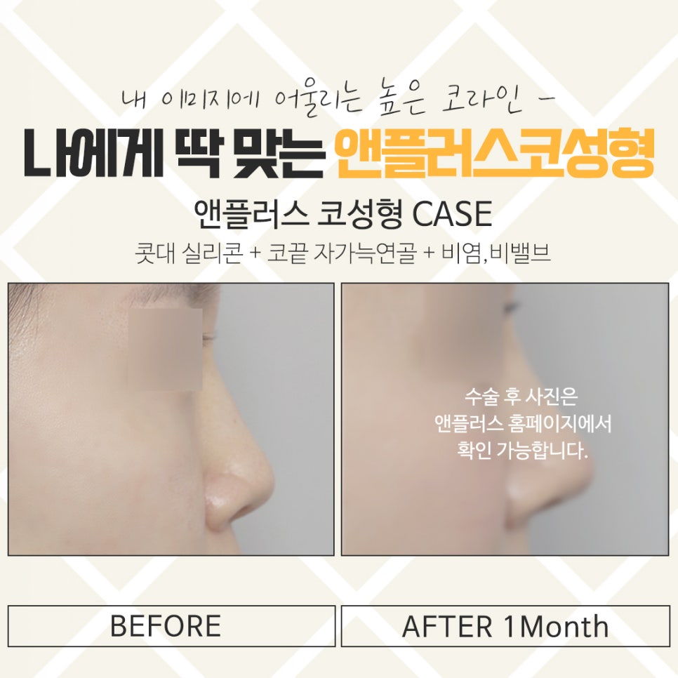 코뼈골절수술 자세하게 알아봐야 관련 이미지 14
