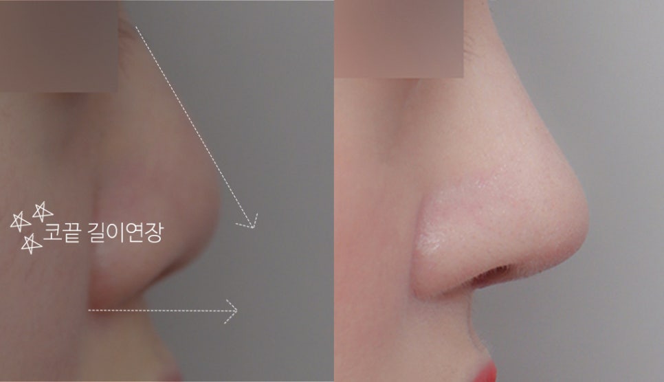 Upturned Nose Surgery_Naturally with Tip Lengthening image 6