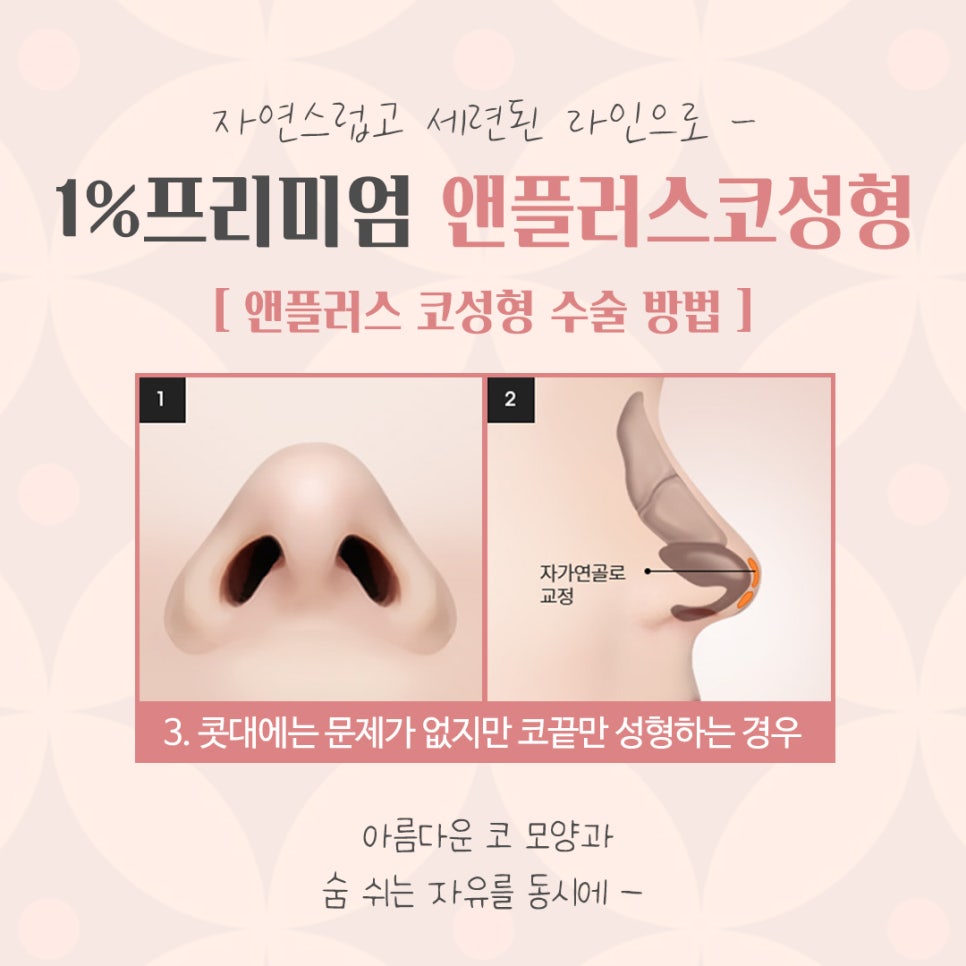 자가늑연골코성형을 통한 이미지 개선 관련 이미지 10