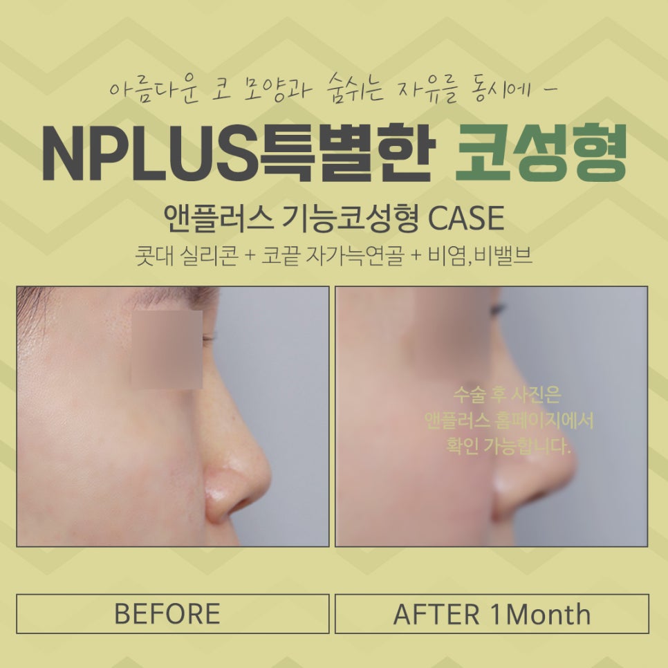 코성형전후 꼼꼼하게 비교하고 결정 관련 이미지 13